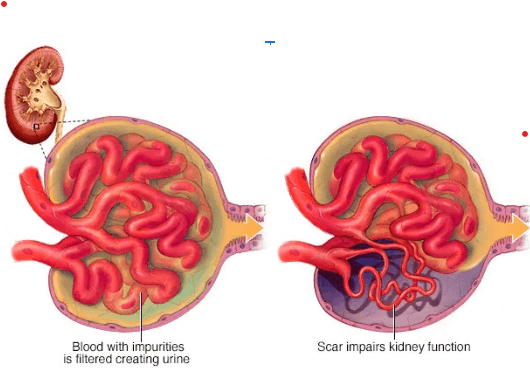 Focal segmental glomerulosclerosis